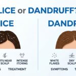 Lice or Dandruff