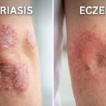 Psoriasis or Eczema